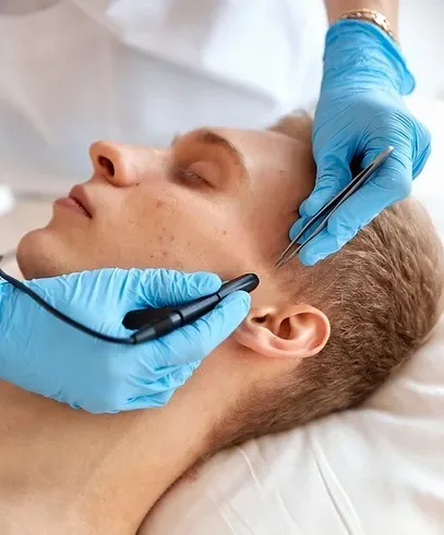 man getting electrolysis on left side burn
